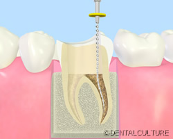 歯内療法とは