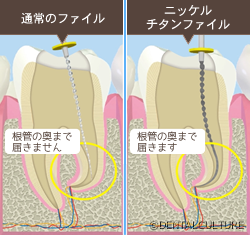 ニッケルチタンファイル（バイオレース）