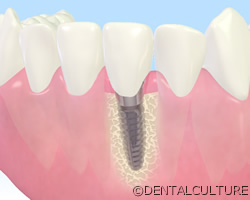 インプラントとは