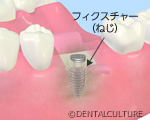 インプラント埋入手術