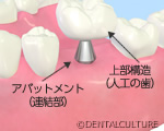 インプラント埋入手術