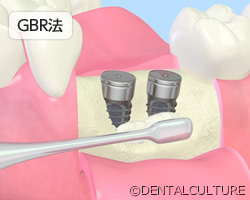 GBR法（骨誘導再生法） 