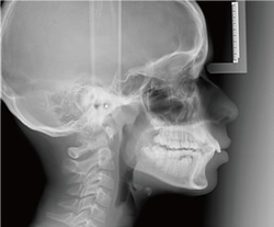 矯正治療に欠かせないセファロ撮影による正確な診断