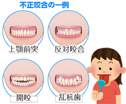 ＭＦＴ：口の周りの筋肉不足による不正咬合の一例