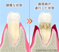 歯周治療